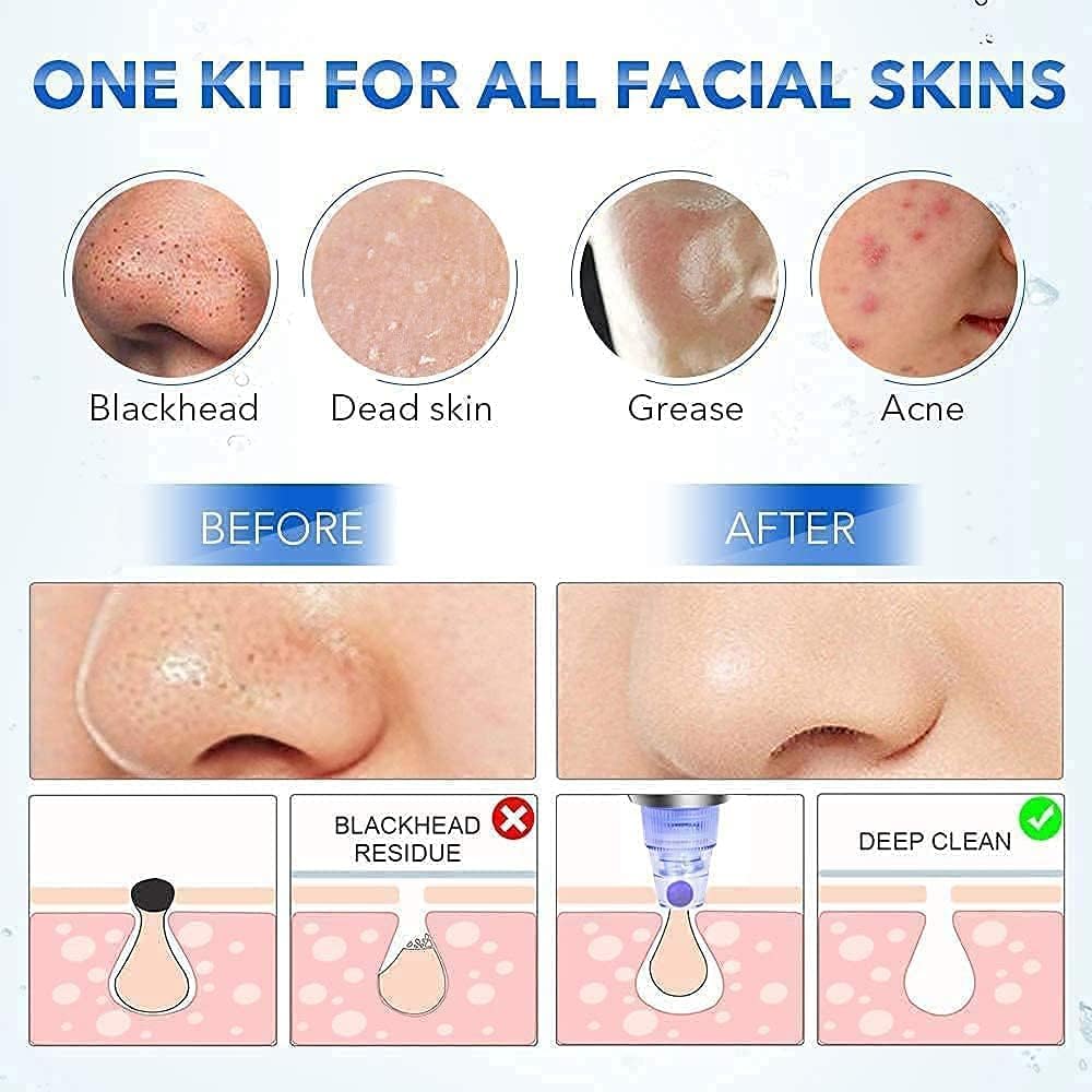 4 in 1 Multi-function Blackhead Remover Tools | Electric Derma suction Machine | Acne Pimple Pore Cleaner Vacuum Tool-Device for Nose & Skin Care